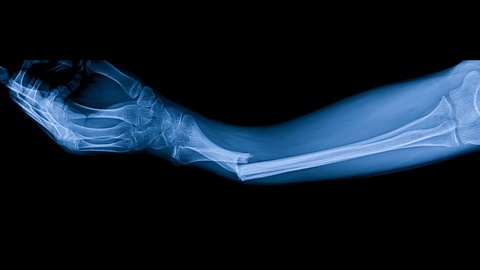 Röntgen von gebrochenem Arm © Shutterstock