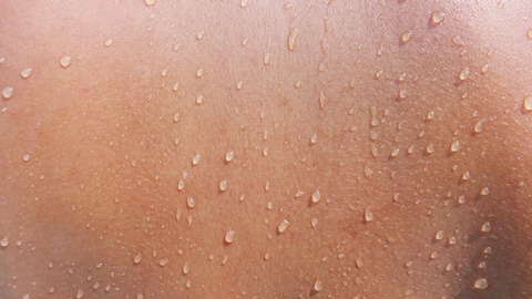 Als Hyperhidrose bezeichnet man eine &uuml;berm&auml;&szlig;ige Schwei&szlig;produktion. Je nach Auspr&auml;gung unterscheidet man verschiedene Schweregrade (Grad I-III). &copy; Shutterstock