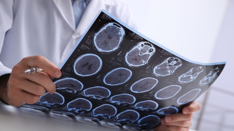 Themenbild Multiple Sklerose &copy; Shutterstock