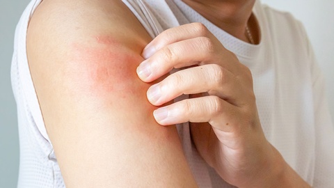 Dermatitis © shutterstock