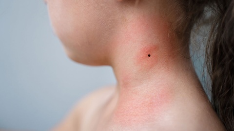 Zeckenstich &copy; Shutterstock