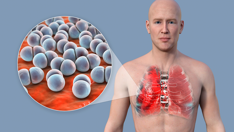 Pneumokokken &copy; shutterstock