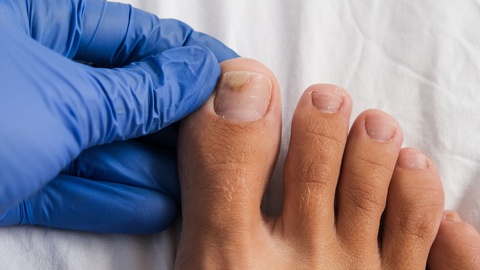 Nagelpilz &copy; shutterstock