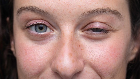 Bei der okularen Mysthenia gravis nimmt der Tonus der Augenmuskulatur ab, wodurch die Augenlider der Erkrankten herabh&auml;ngen (Ptosis). &copy; Shutterstock