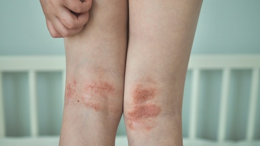 Neurodermitis © Shutterstock