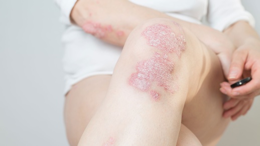 Psoriasis © Shutterstock