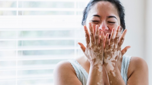 Vitiligo © iStock