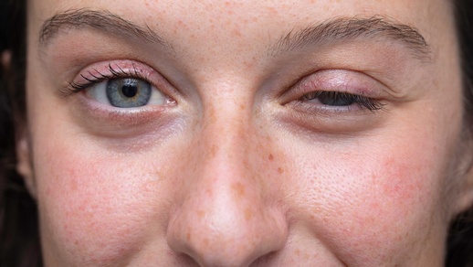 Myasthenia gravis © Shutterstock