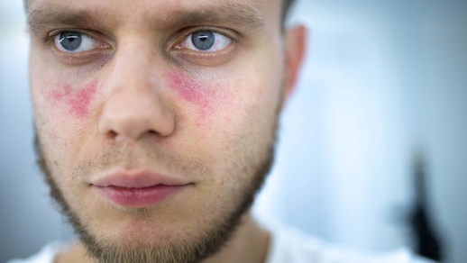 Lupus © Shutterstock