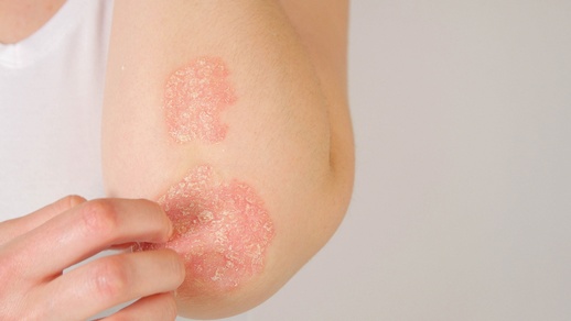 Rötlich umrandete, scharf begrenzte Herde mit silbrig-glänzenden Schuppen sind typisch für Psoriasis. © Shutterstock
