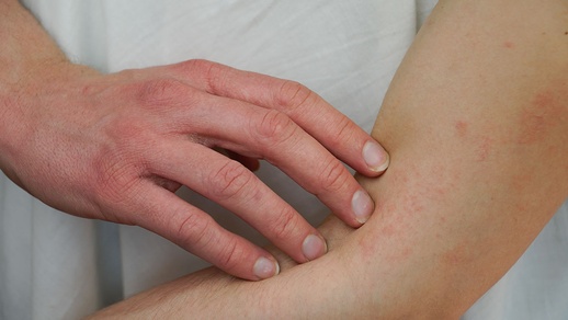 Frau mit Hautausschlag. © Shutterstock