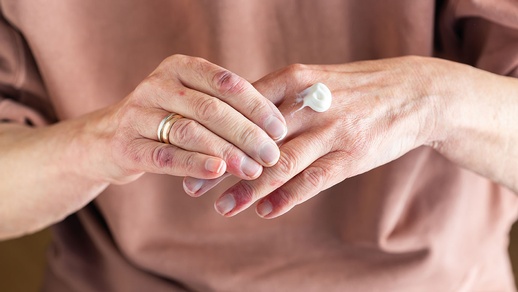 Creme für Neurodermitis © iStock