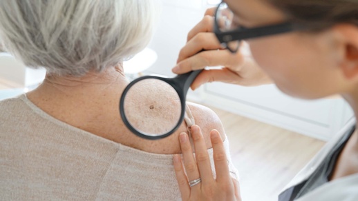 Hautkrebs © shutterstock