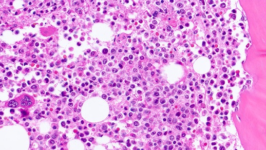 Mikroskopische Sicht der Myelofibrose © shutterstock