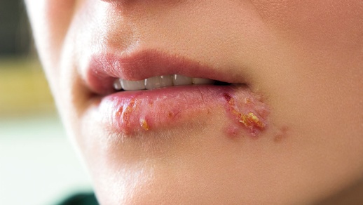 Herpes © shutterstock