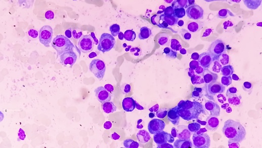 multiple Myelom © shutterstock