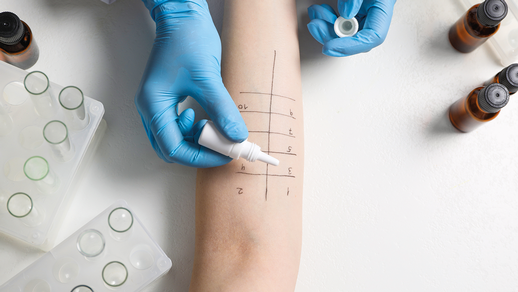 Während klassische Allergien mit dem Prick-Test gut nachweisbar sind, gestaltet sich die Diagnose einer Histaminintoleranz deutlich schwieriger. Oft ist es ein langer Weg, bis die Ursache für pseudoallergischen Symptome gefunden wird. © AdobeStock