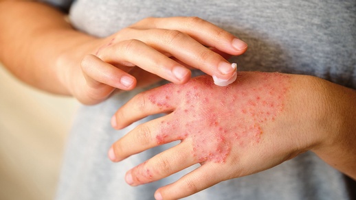 Kinder mit Autismus haben erhöhte Serumspiegel proinflammatorischer Zytokine – ein möglicher Zusammenhang mit atopischer Dermatitis? © Shutterstock