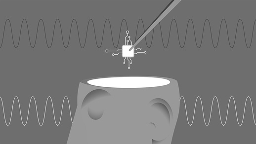 Comichafte Darstellung vom Einsetzten eines Mikrochips in das menschliche Gehirn. © iStock
