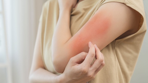 Hautirritation © Shutterstock