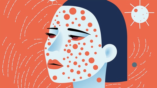 Frau mit Masern © Shutterstock