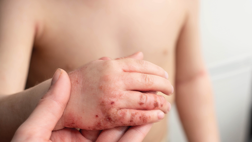 Hautentzündung © Shutterstock