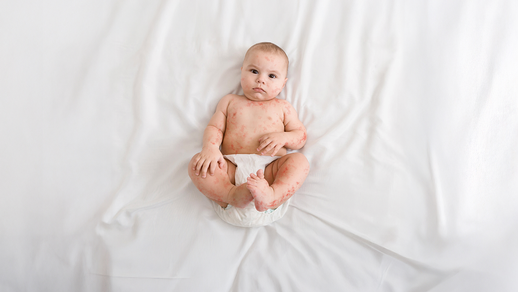 Baby mit Masern © Shutterstock