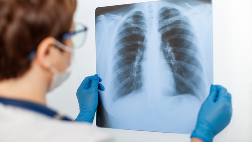 Lungenerkrankung © Shutterstock