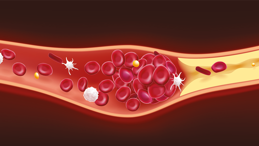 Thrombose © Shutterstock