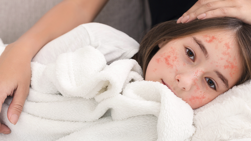 Masern © Shutterstock