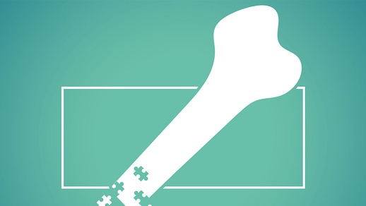 Die langjährige  Einnahme von L-Thyroxin bewirkt einen Verlust  an Knochendichte. © Shutterstock