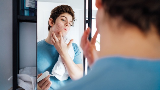 Akne-Therapien © shutterstock
