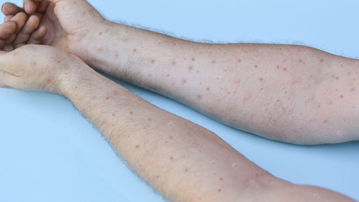 Affenpocken © shutterstock