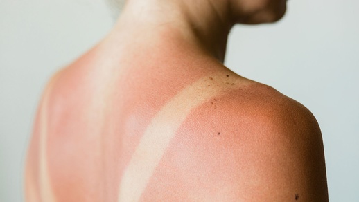 Sonnenbrand © shutterstock