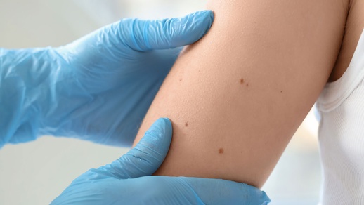 Hautkrebs © shutterstock