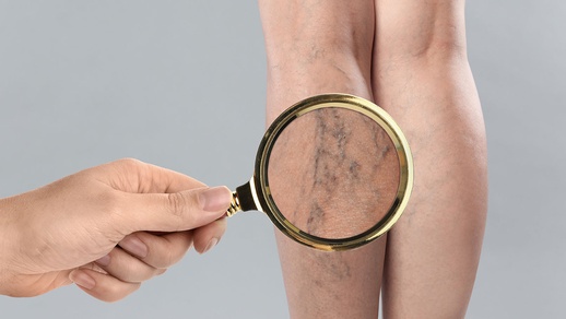 Venengesundheit © shutterstock