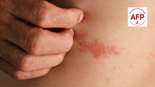 Post Zoster © Shutterstock/APOVERLAG