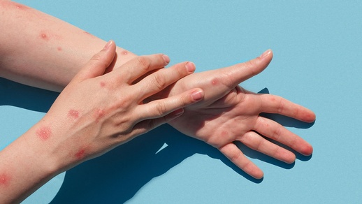 Affenpocken © shutterstock