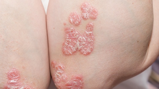 Ein Hautausschlag bei Psoriasis. © Shutterstock