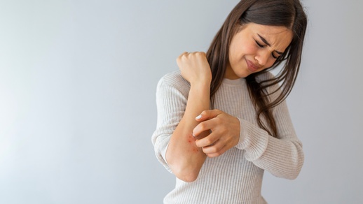 Eine Frau kratzt sich am Ellenbogen. © Shutterstock