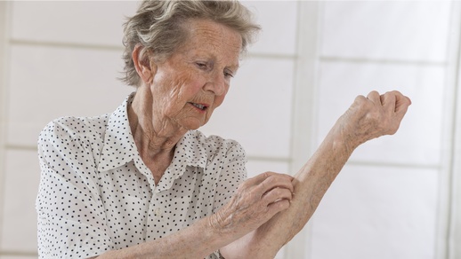 Eine ältere Frau leidet unter Juckreiz und kratzt sich an den Unterarmen. © Shutterstock
