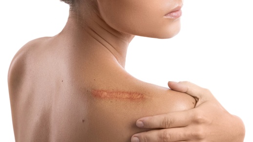Auf der Schulter einer Frau ist eine große Narbe zu sehen. © Shutterstock