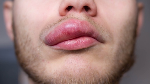 Ein Mann mit einer geschwollenen Lippe. © Shutterstock