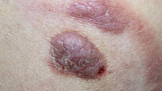 Kutanes Lymphom © Shutterstock