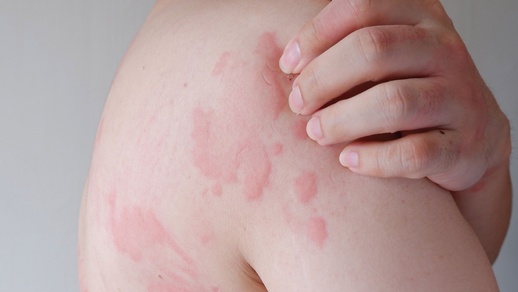 Patient mit Urtikaria © Shutterstock