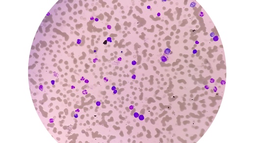 Morbus Waldenström © Shutterstock