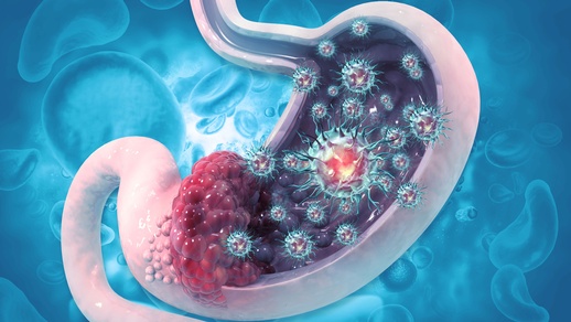 Magenkrebs © Shutterstock