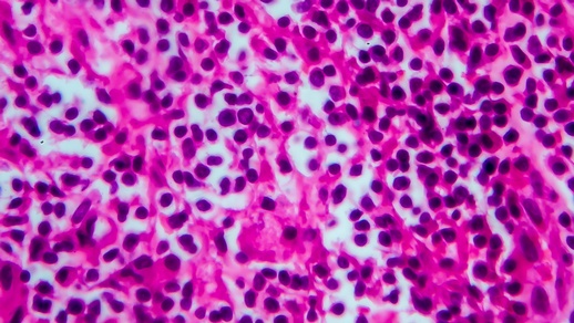 Non Hodgkin Lymphom © Shutterstock