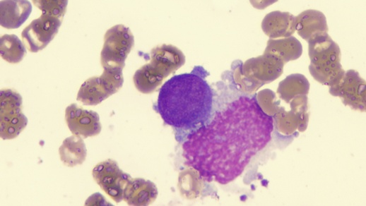 Symbolbild Myelofibrose © Shutterstock