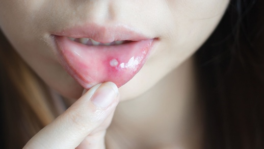 Aphthen ähneln zwar einer Herpes-Infektion, sind aber im Gegensatz dazu nicht ansteckend und heilen meist von selbst ab.  © Shutterstock